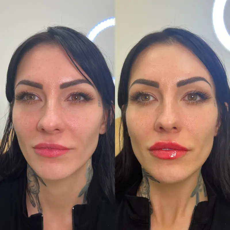 KUR Modern Medical Aesthetics lip filler in Cleveland OH