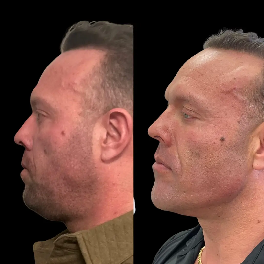 KUR Modern Medical Aesthetics male facial contouring in Cleveland OH