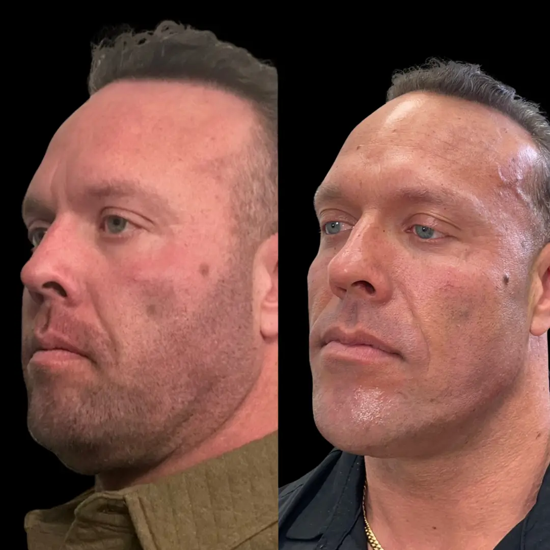 KUR Modern Medical Aesthetics male facial contouring in Cleveland OH