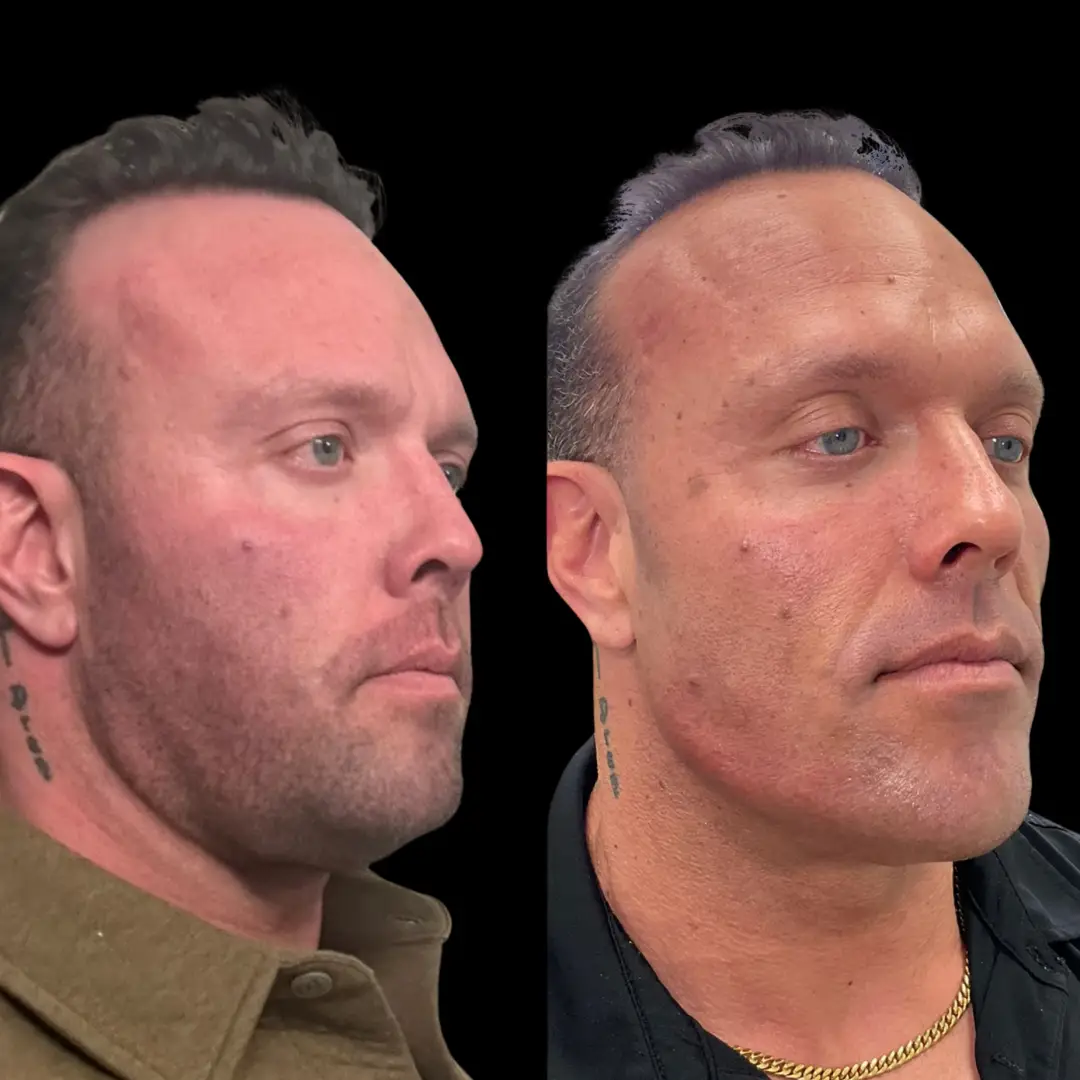 KUR Modern Medical Aesthetics male facial contouring in Cleveland OH