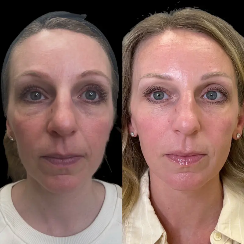 KUR Modern Medical Aesthetics sculptra in Cleveland OH