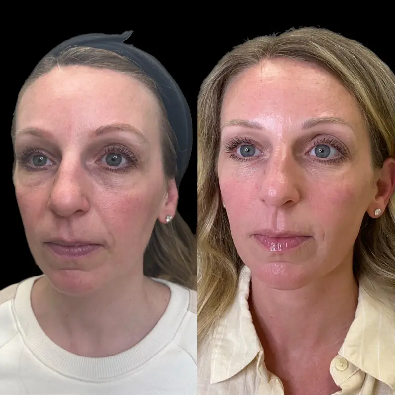 KUR Modern Medical Aesthetics sculptra in Cleveland OH