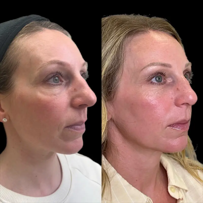 KUR Modern Medical Aesthetics sculptra in Cleveland OH