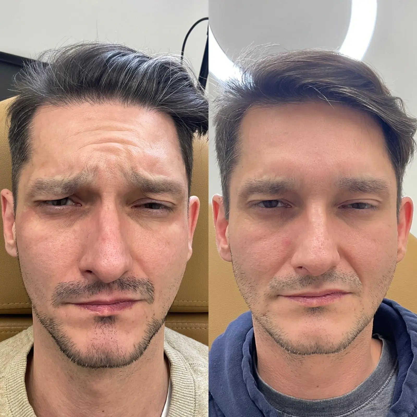 Botox Dysport Before After in Cleveland, OH