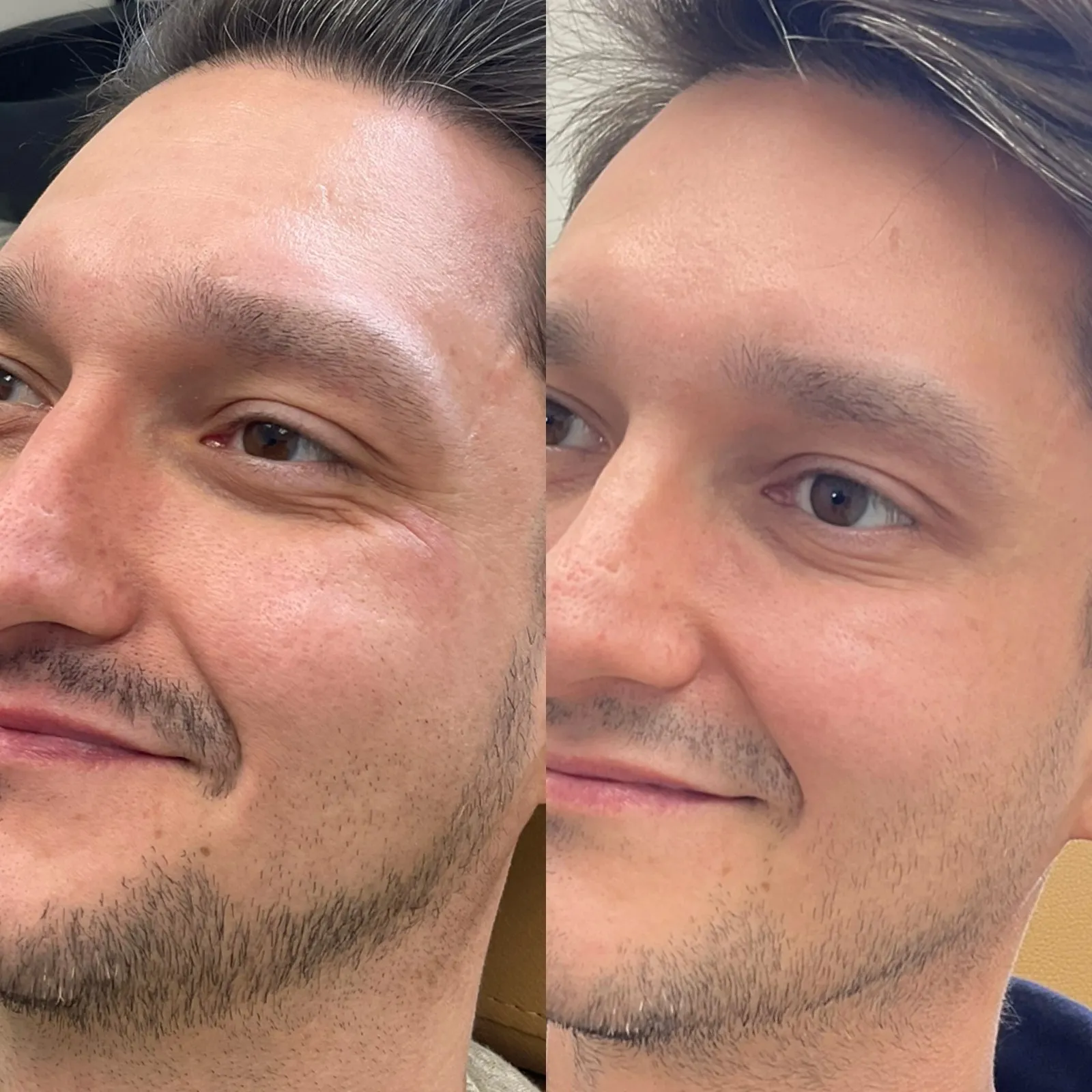 Botox Dysport Before After in Cleveland, OH