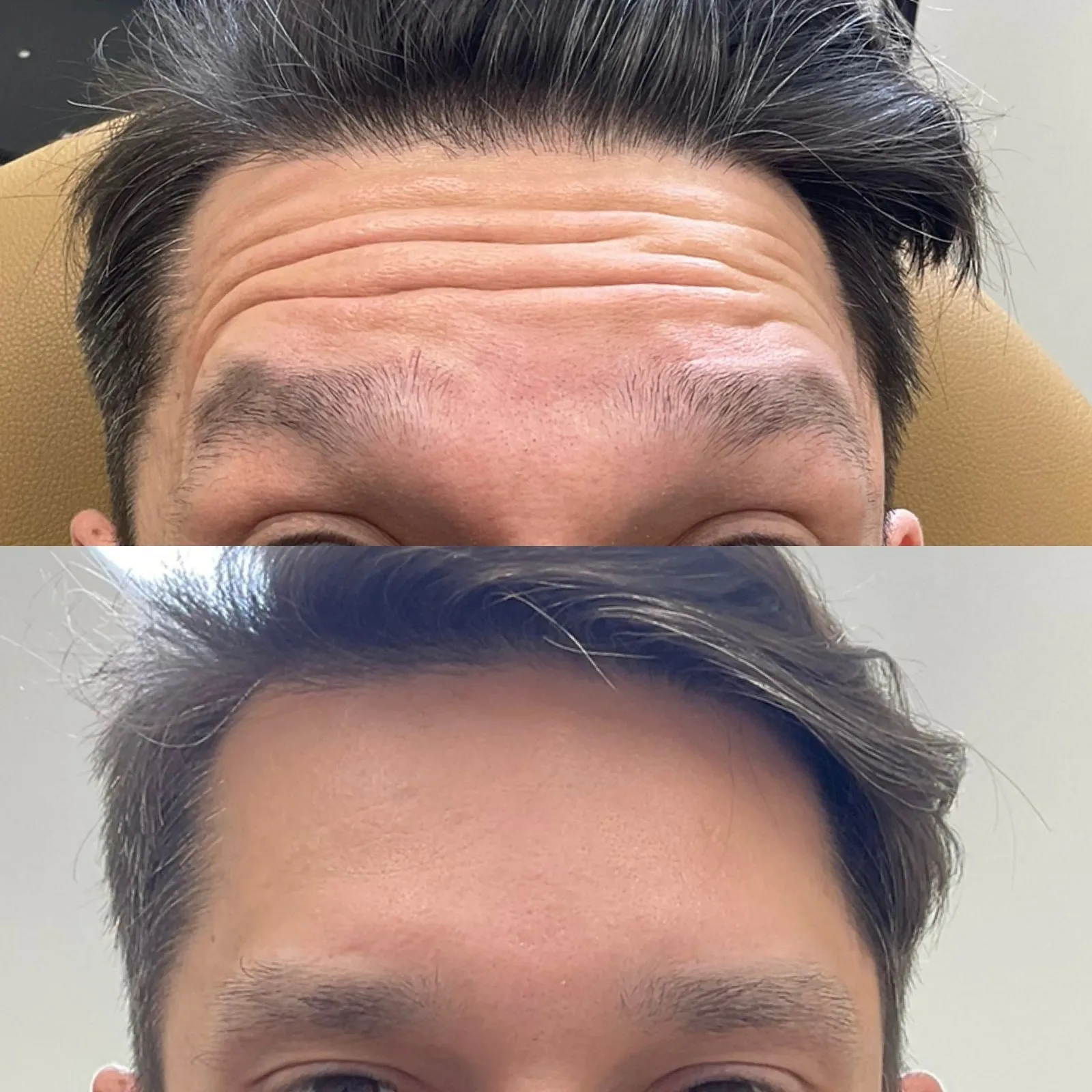 Botox Dysport Before After in Cleveland, OH