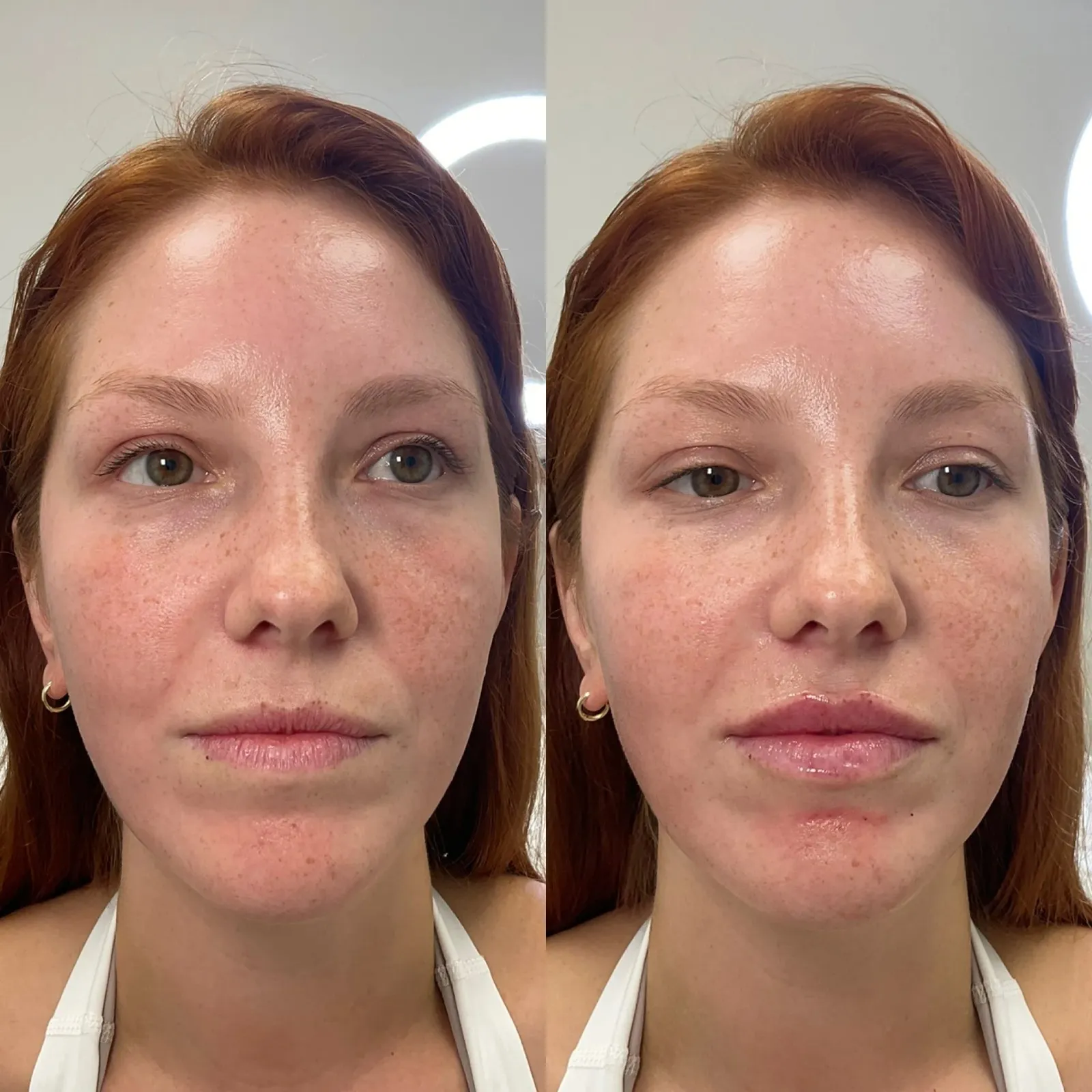 Lip Fillers Before After in Cleveland, OH