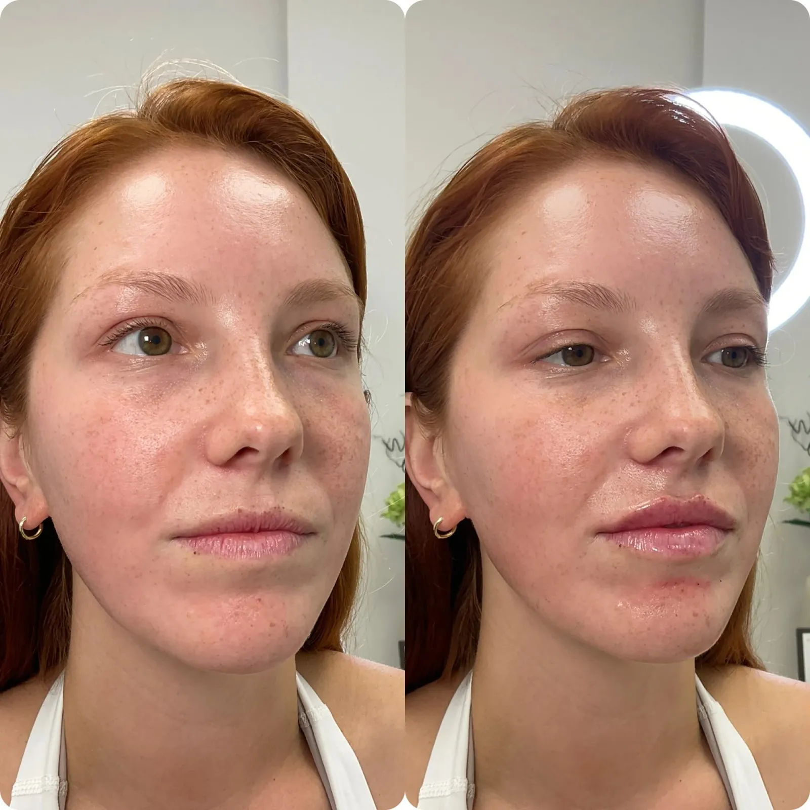 Lip Fillers Before After in Cleveland, OH