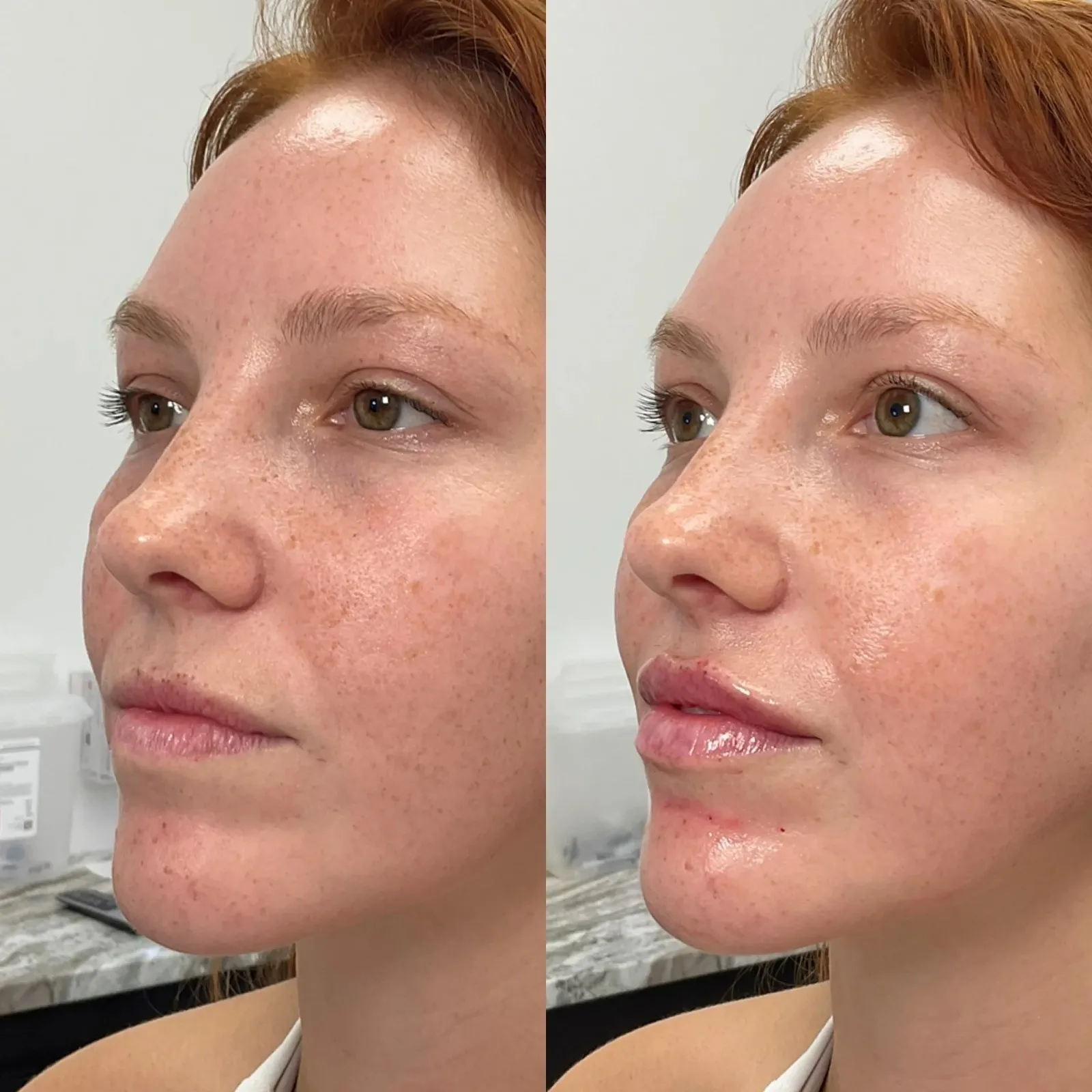 Lip Fillers Before After in Cleveland, OH