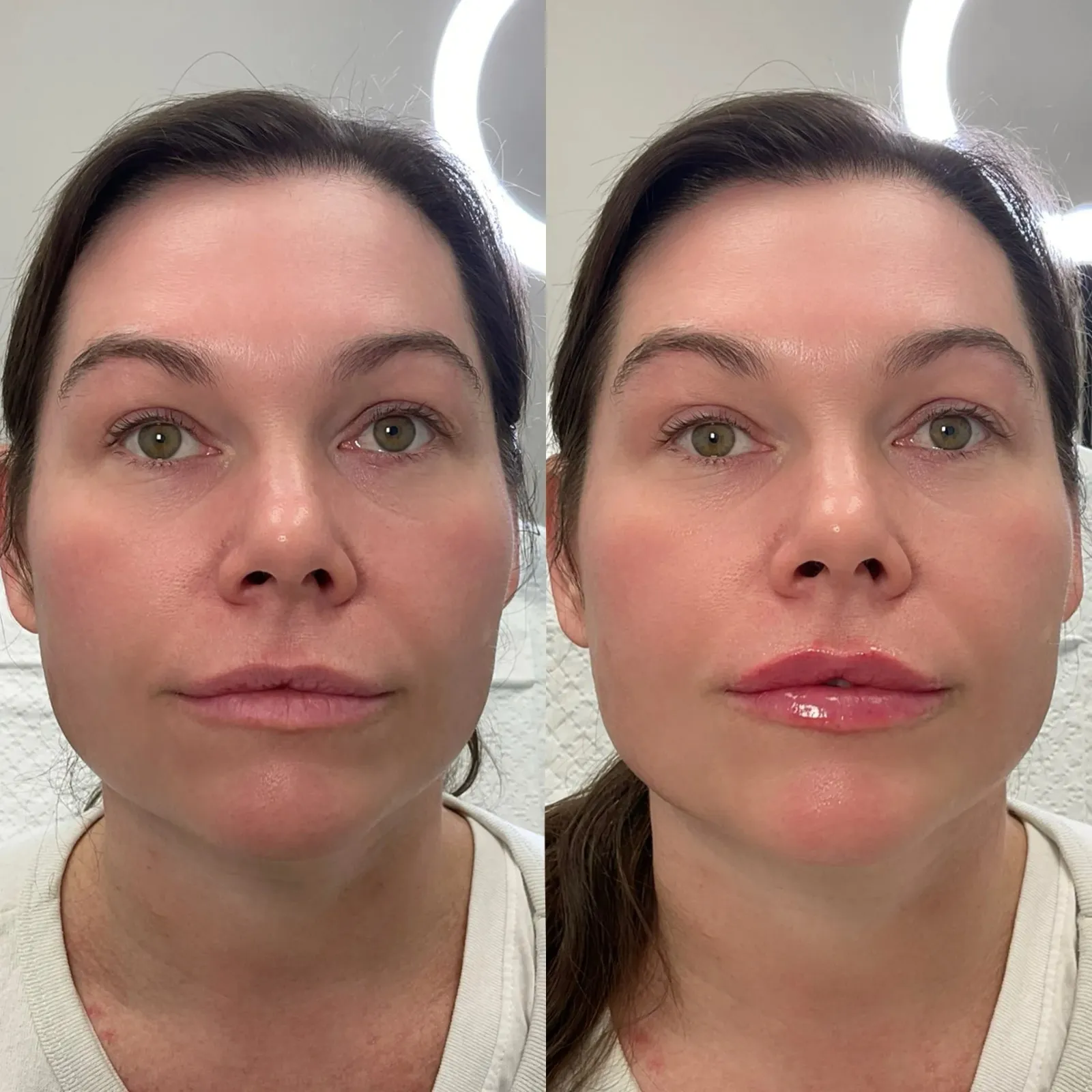 Lip Fillers Before After in Cleveland, OH | KUR Medical Spa