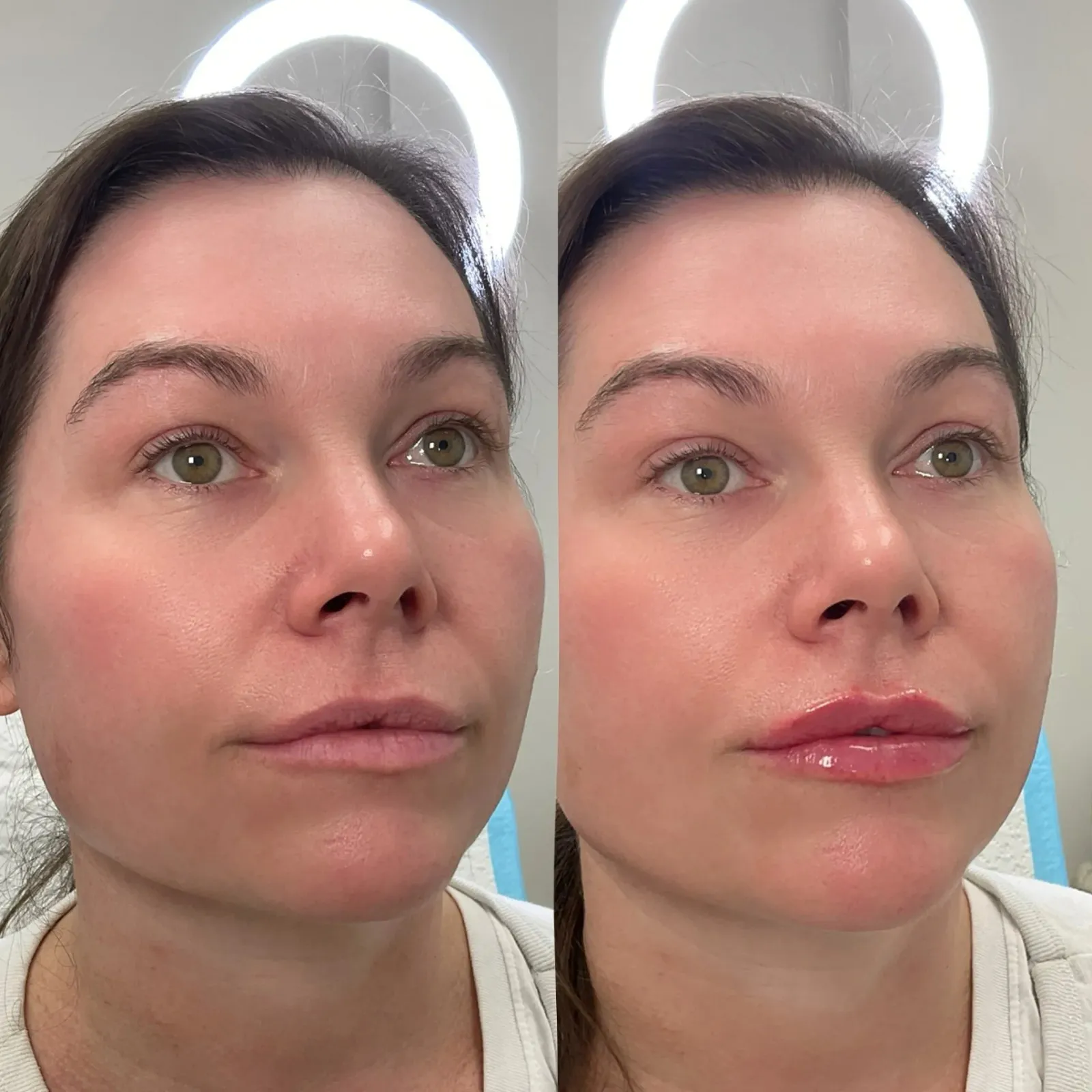 Lip Fillers Before After in Cleveland, OH | KUR Modern Medical Aesthetics