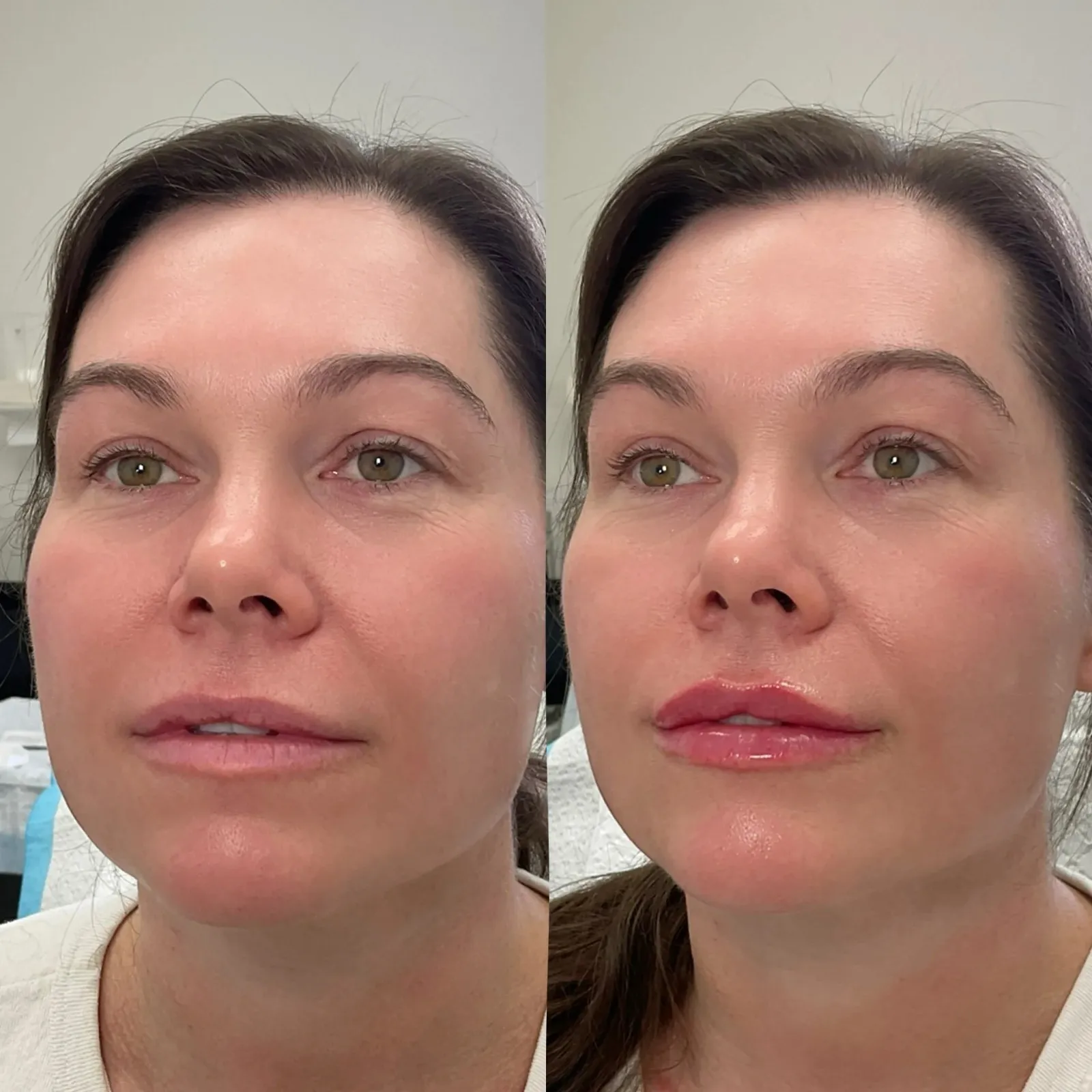 Lip Fillers Before After in Cleveland, OH | KUR Modern Medical Aesthetics