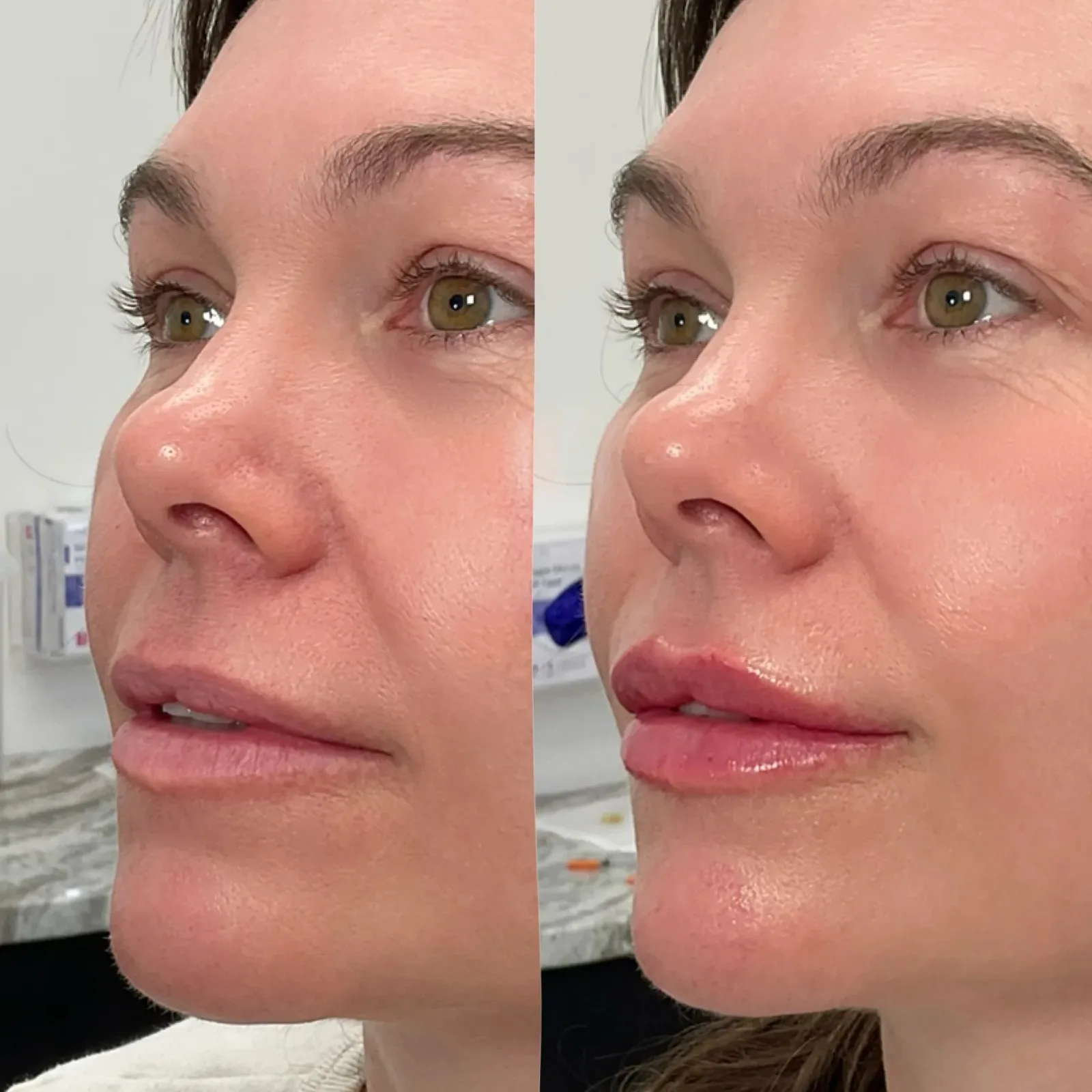 Lip Fillers Before After in Cleveland, OH | KUR Modern Medical Aesthetics