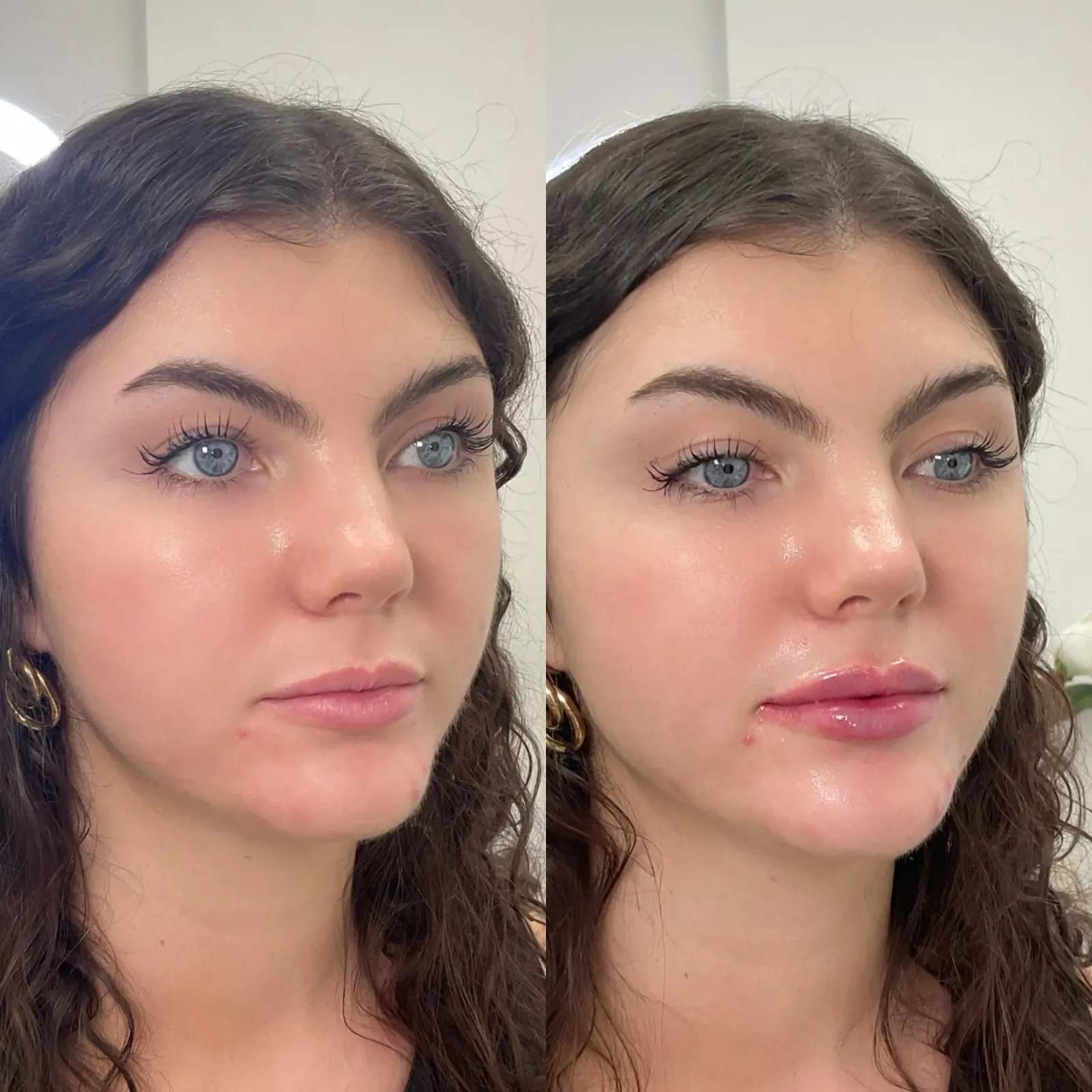 Lip Fillers Before After in Cleveland, OH | KUR Modern Medical Aesthetics