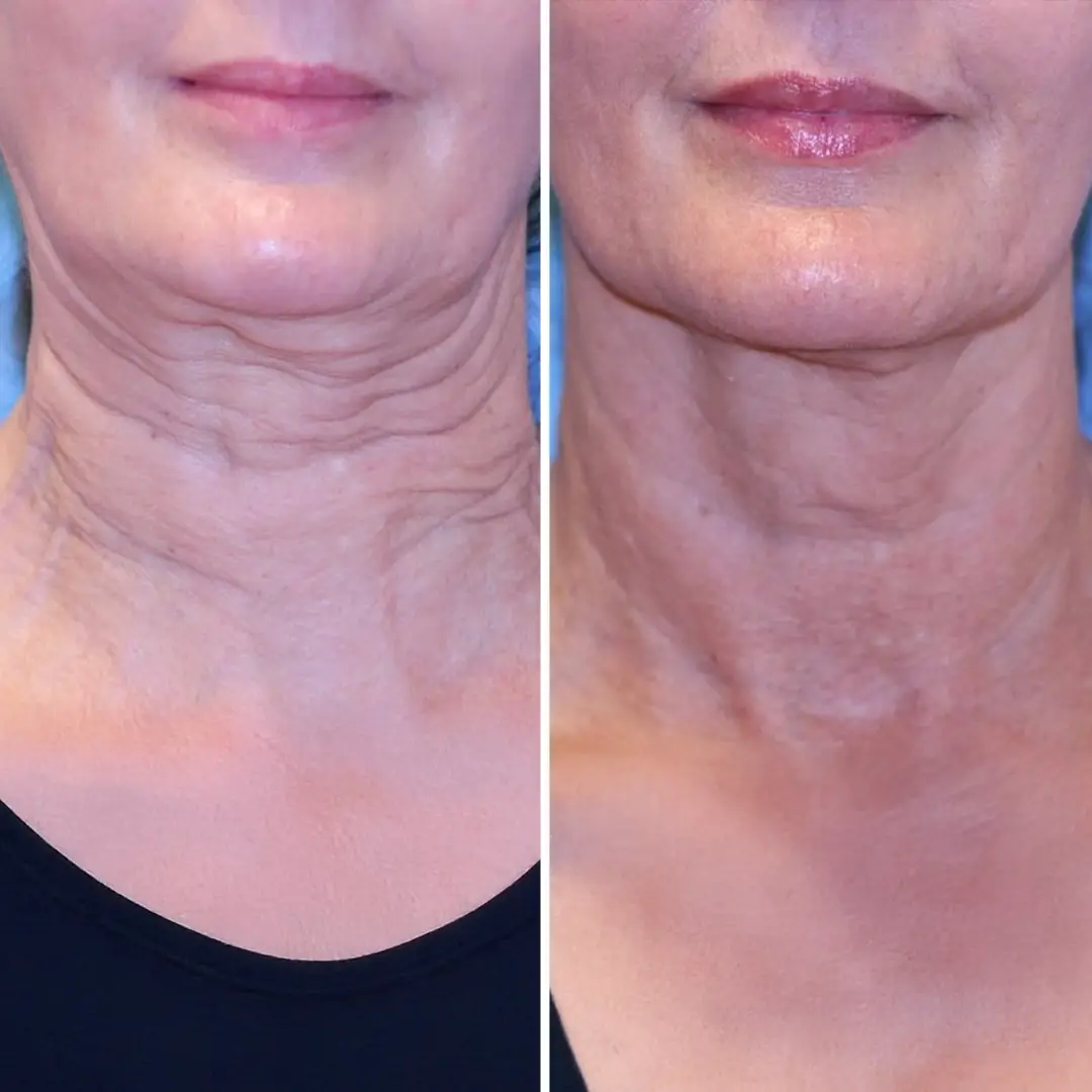 Neck