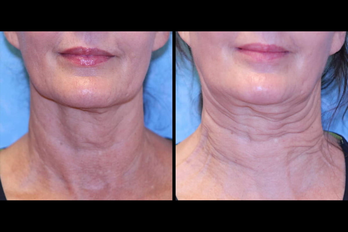 Sofwave™ before and after showing improvement in neck wrinkles, skin texture, and firmness with smoother, tighter-looking skin after treatment.